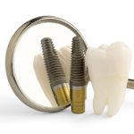 Dental Imlant