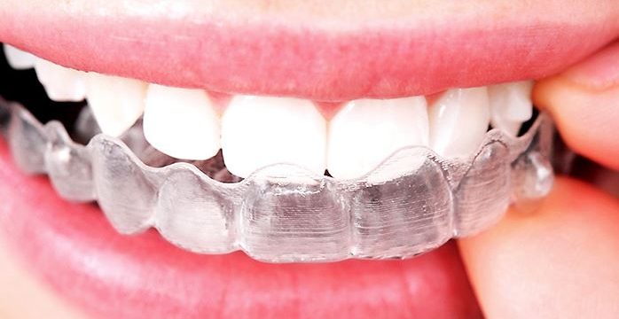 lake-worth-invisalign