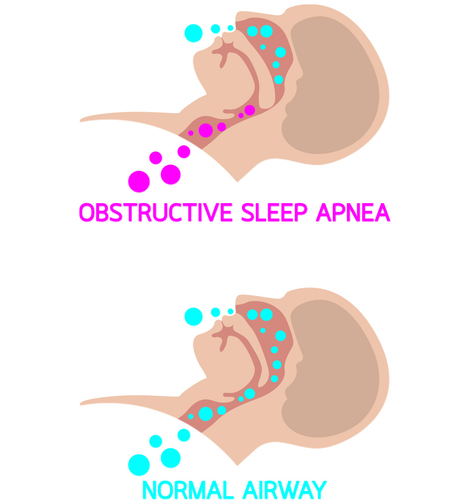 Sleep Apnea Diagram - Dental Arts of Atlantis