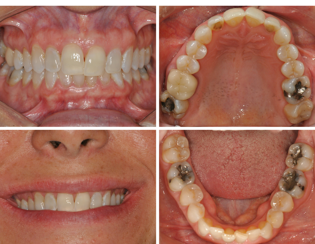 west_palm_beach_invisalign