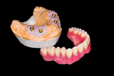 Ditch the Adhesives! Stabilize your Dentures with Implants Today.
