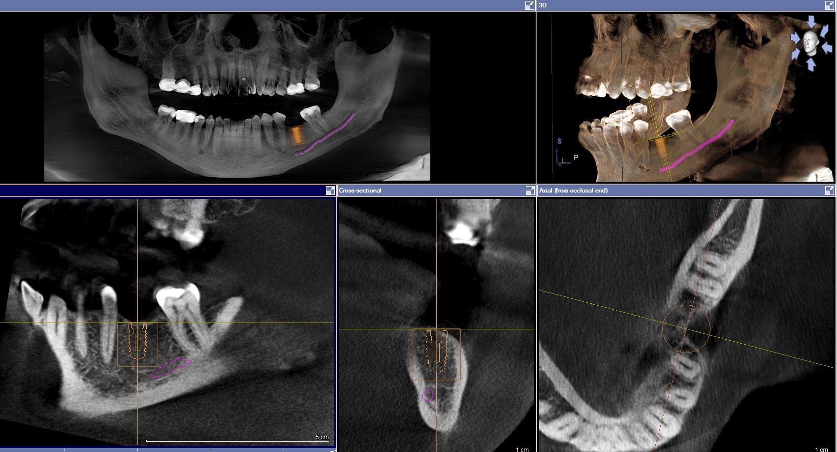 CBCT