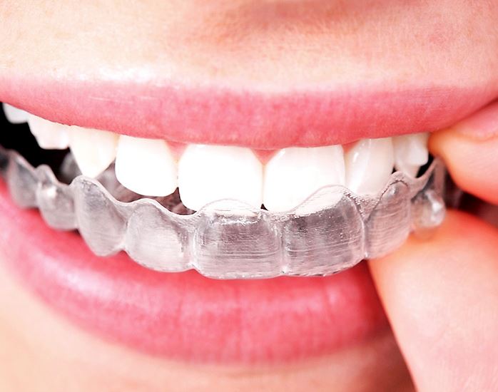 Maintaining Your Post-Invisible Aligner Smile