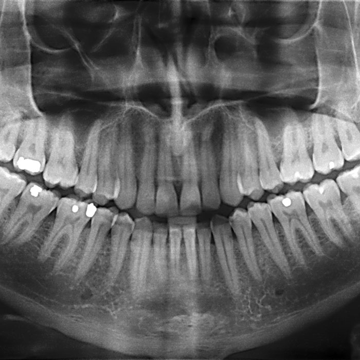 Dental X-Rays: What You Need To Know