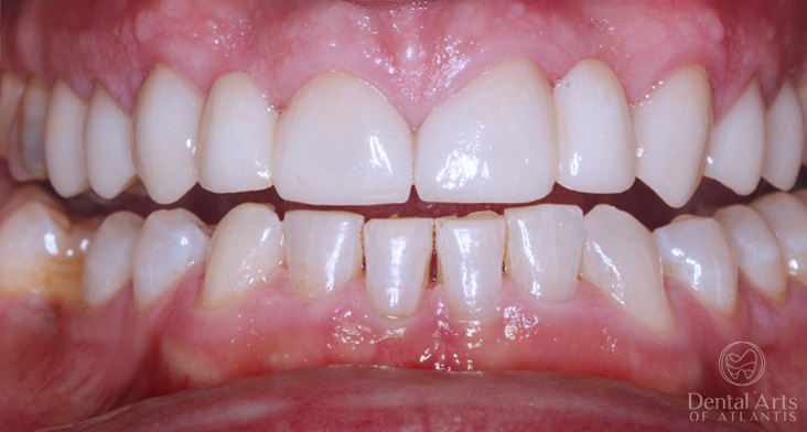 dental-arts-of-atlantis-cosmetic-rehab-after
