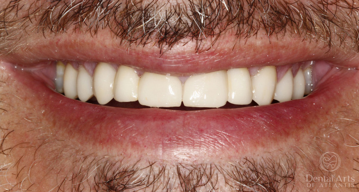 dental-arts-of-atlantis-cosmetic_rehab_gum_lift_veneers_and_implants-after