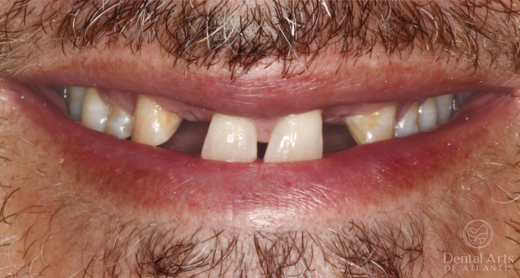dental-arts-of-atlantis-cosmetic_rehab_gum_lift_veneers_and_implants-before