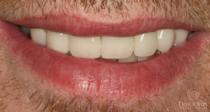 dental-arts-of-atlantis-cosmetic_rehab_veneers_and_crowns-after
