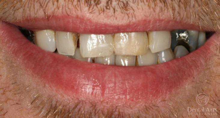 dental-arts-of-atlantis-cosmetic_rehab_veneers_and_crowns-before