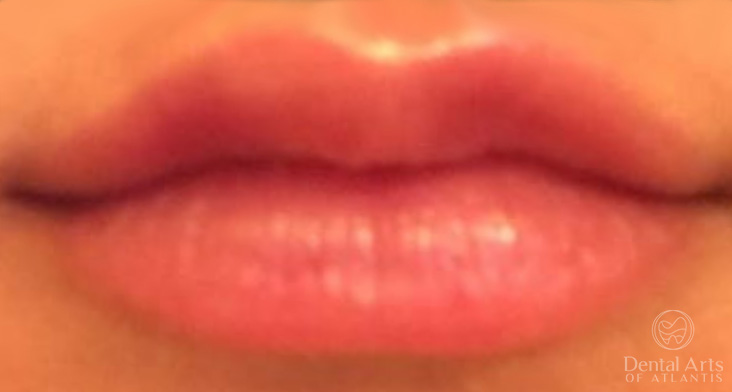 dental-arts-of-atlantis-dermal-fillers-after