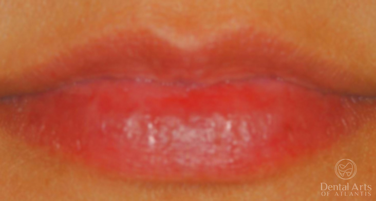 dental-arts-of-atlantis-dermal-fillers-before