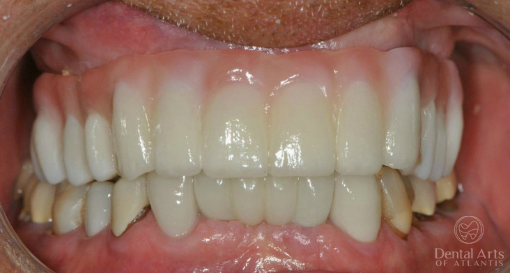 dental-arts-of-atlantis-full-mouth-rehab-after