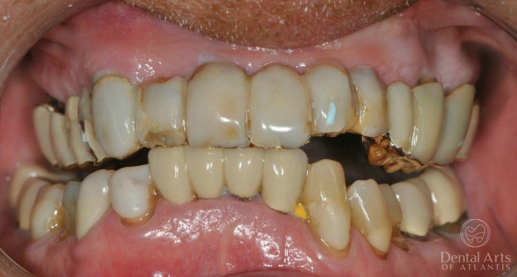 dental-arts-of-atlantis-full-mouth-rehab-before