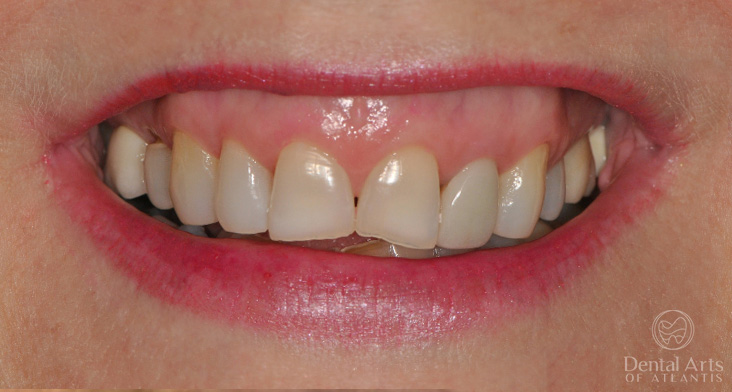 dental-arts-of-atlantis-gummy-smile-treatment-with-botox-after