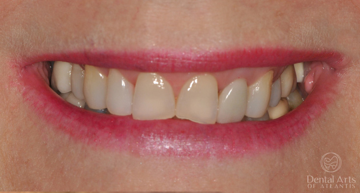 dental-arts-of-atlantis-gummy-smile-treatment-with-botox-before