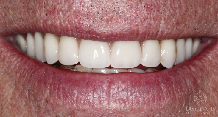 dental-arts-of-atlantis-hybrid_implant_dentures-after