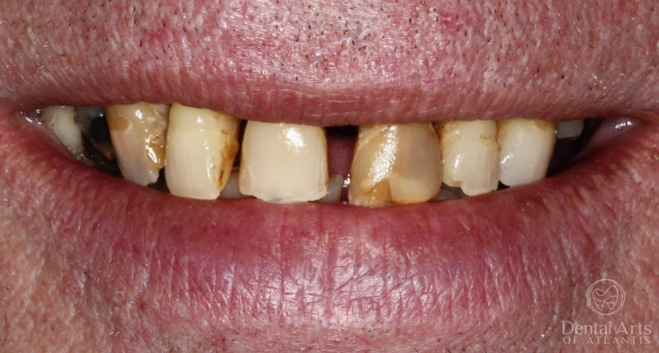dental-arts-of-atlantis-hybrid_implant_dentures-before