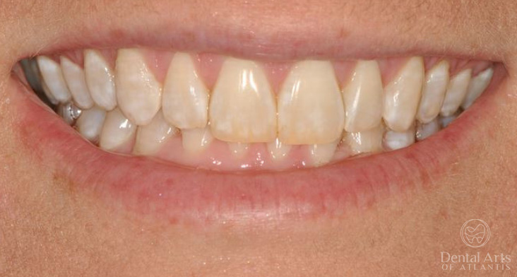 dental-arts-of-atlantis-invialign-2-after