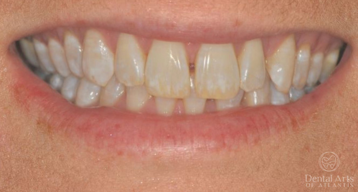 dental-arts-of-atlantis-invialign-2-before