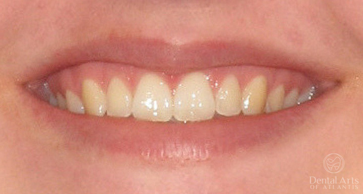 dental-arts-of-atlantis-invialign-after