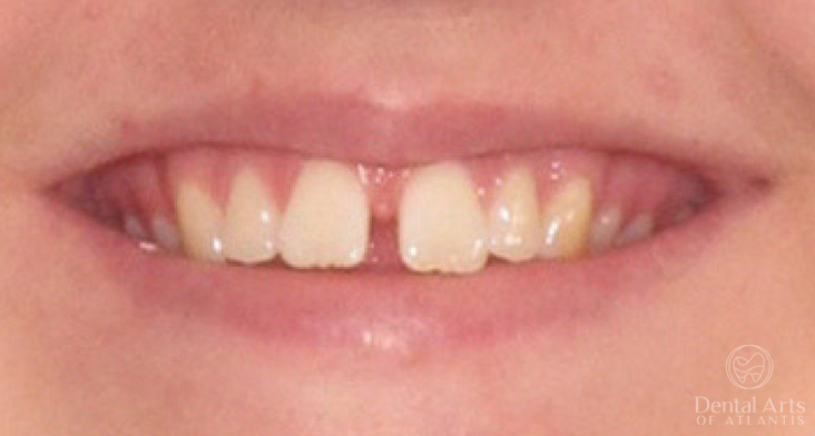 dental-arts-of-atlantis-invialign-before