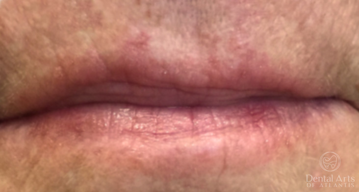 dental-arts-of-atlantis-restylane-before