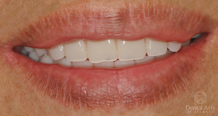 dental-arts-of-atlantis-smile-makeover-after