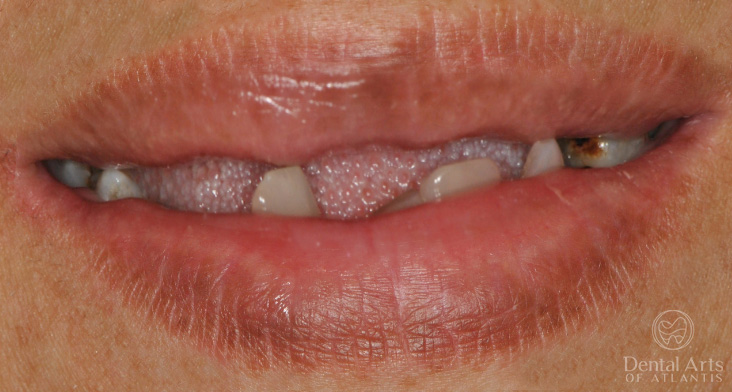 dental-arts-of-atlantis-smile-makeover-before