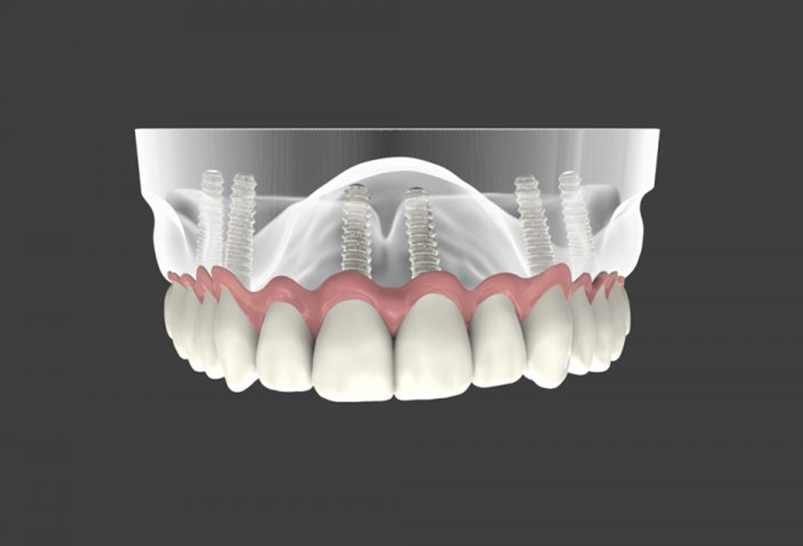 denture-implants